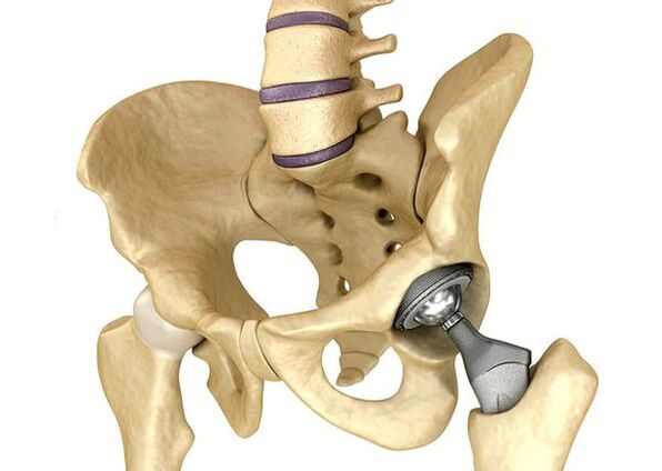 Endoprothetic of the hip joint