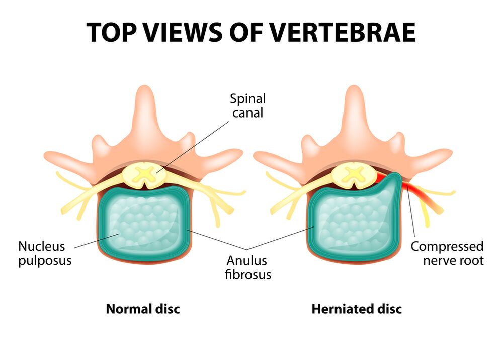 Sano and hernia intervertebral disc