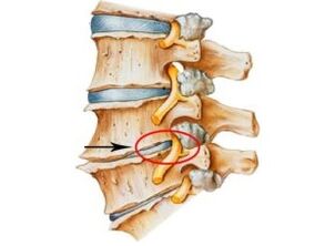 Signs and symptoms of osteochondosis
