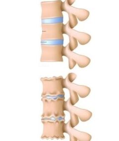 The causes of osteochondosis