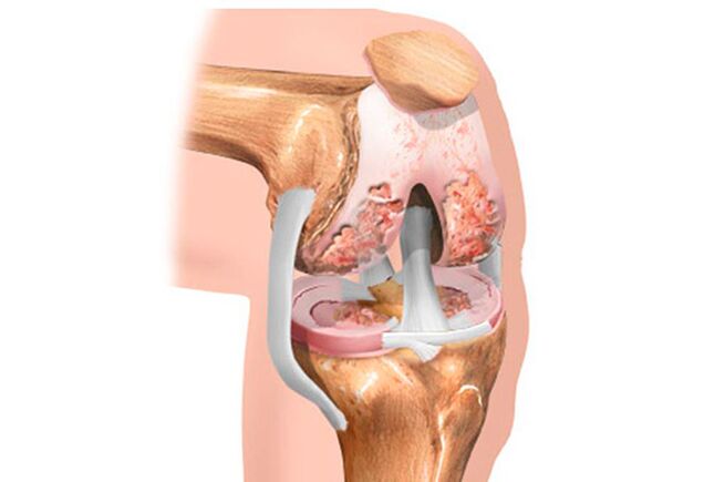 Atrosis of the knee joint