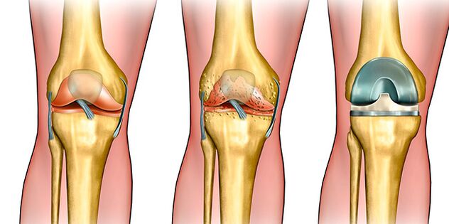 In the third stage of osteoarthritis, knee replacement is necessary