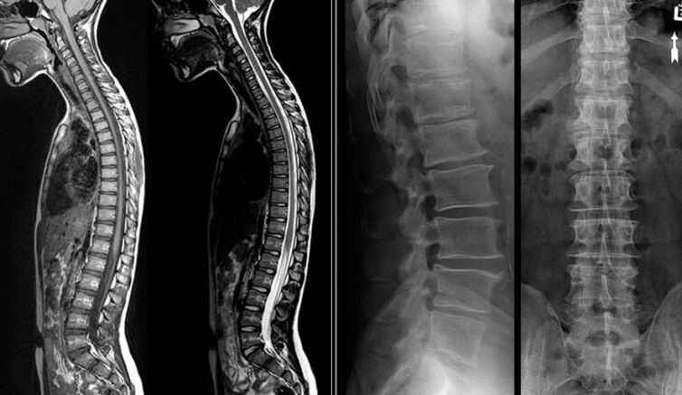 X-ray and MRI images for osteochondrosis