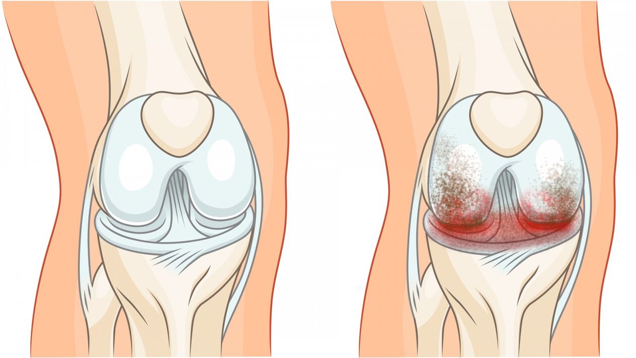 healthy joint and osteoarthritis of the knee joint