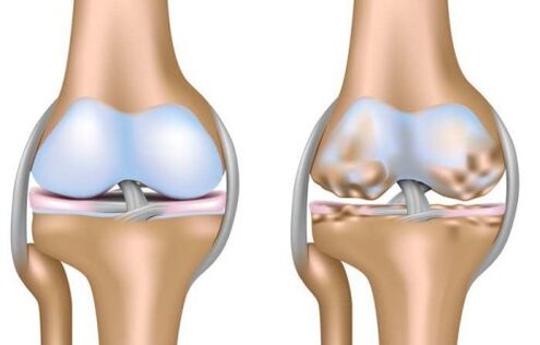 healthy joint and destruction of the knee joint in osteoarthritis