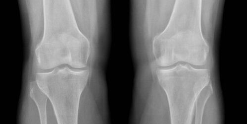 x-ray of osteoarthritis of the knee