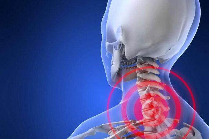 Shooting pain in the neck - one of the first symptoms of cervical osteochondrosis