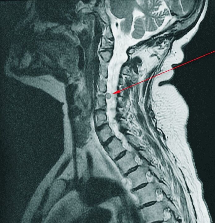 Intervertebral hernia of the cervical spine on magnetic resonance imaging