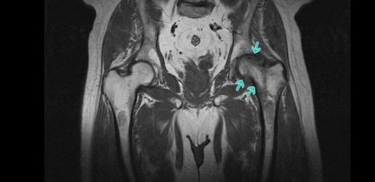 Degenerative-dystrophic changes of the hip joint on MRI