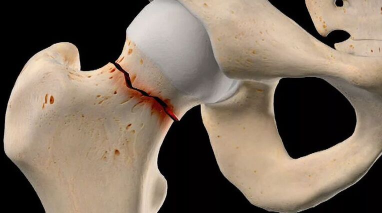 Fracture of the femoral neck is one of the causes of secondary coxarthrosis. 